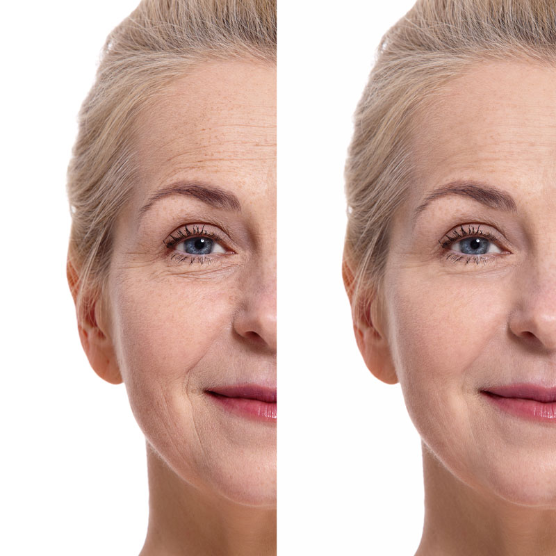wrinkle treatment in jaipur