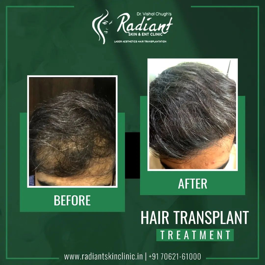Hair Transplant Clinic in Jaipur