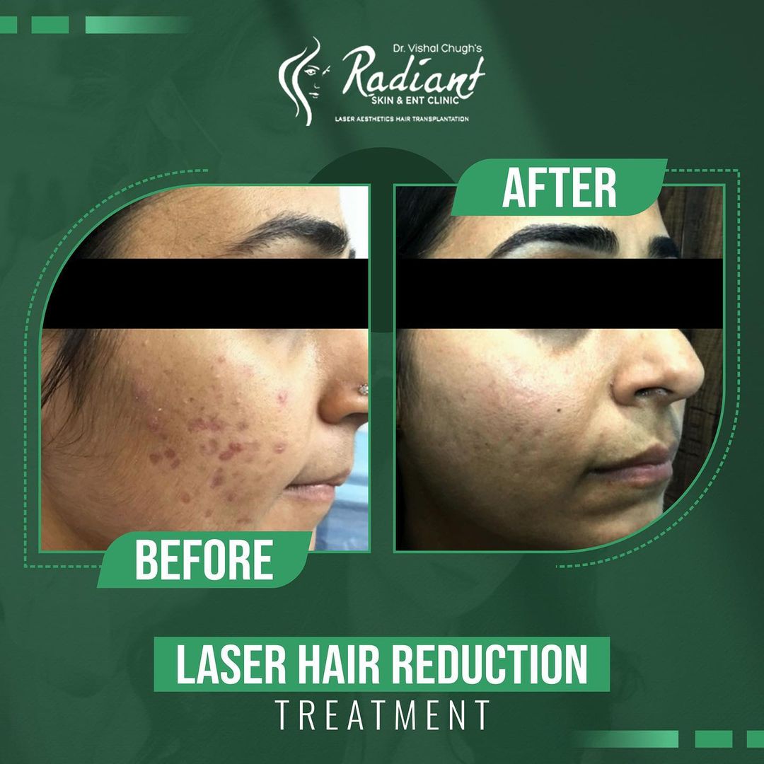 Laser Hair Removal Treatment in Jaipur
