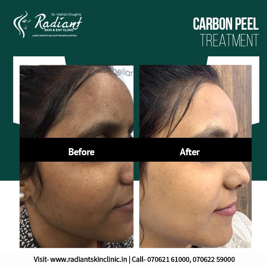 Best Carbon Peel Treatment in Jaipur