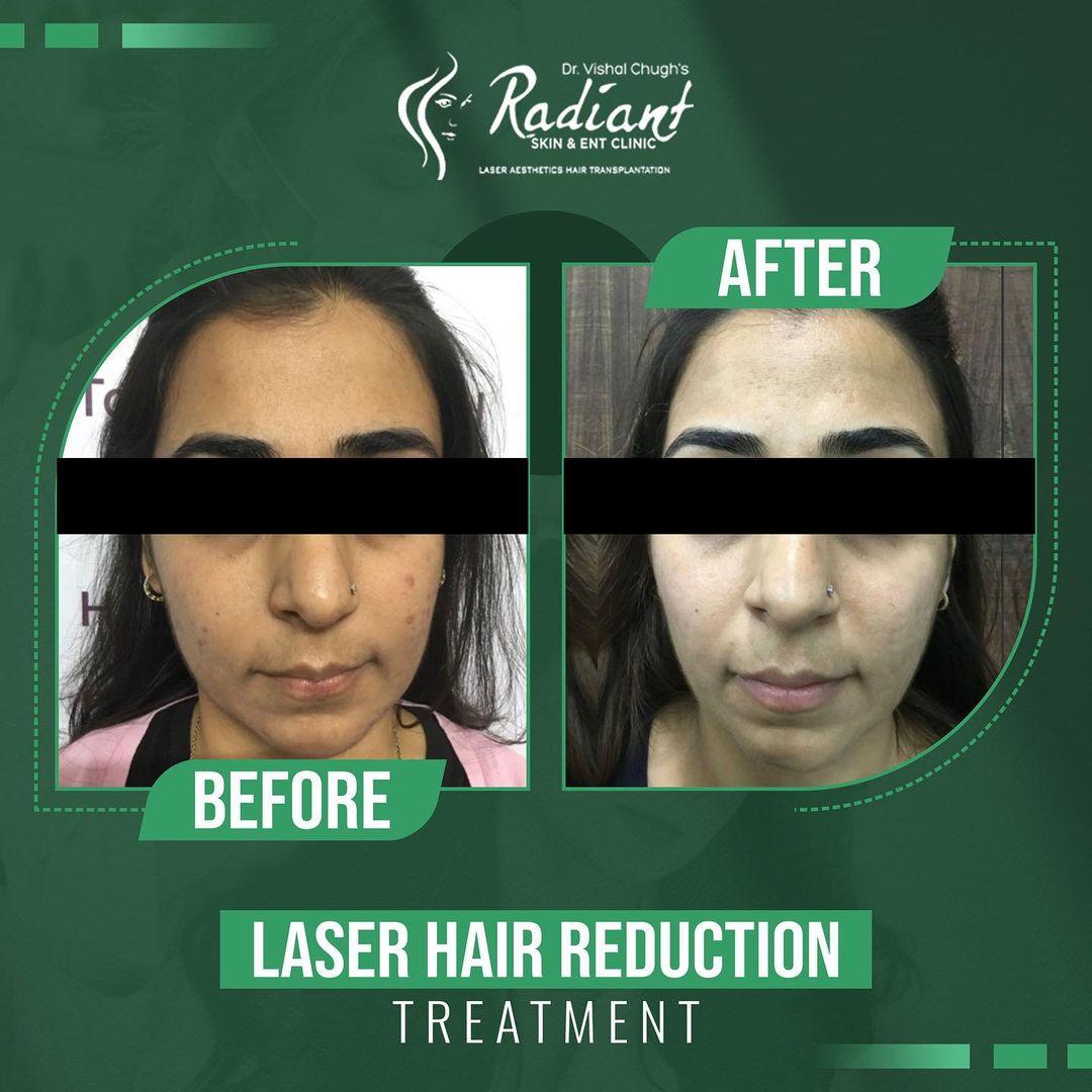 Laser hair Removal Clinic in Jaipur