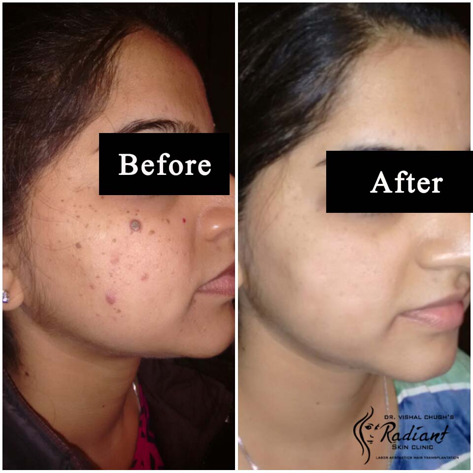 Acne Scar Laser Treatment in Jaipur