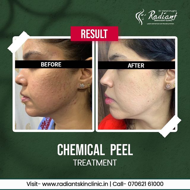 Best Chemical Peel Treatment Jaipur