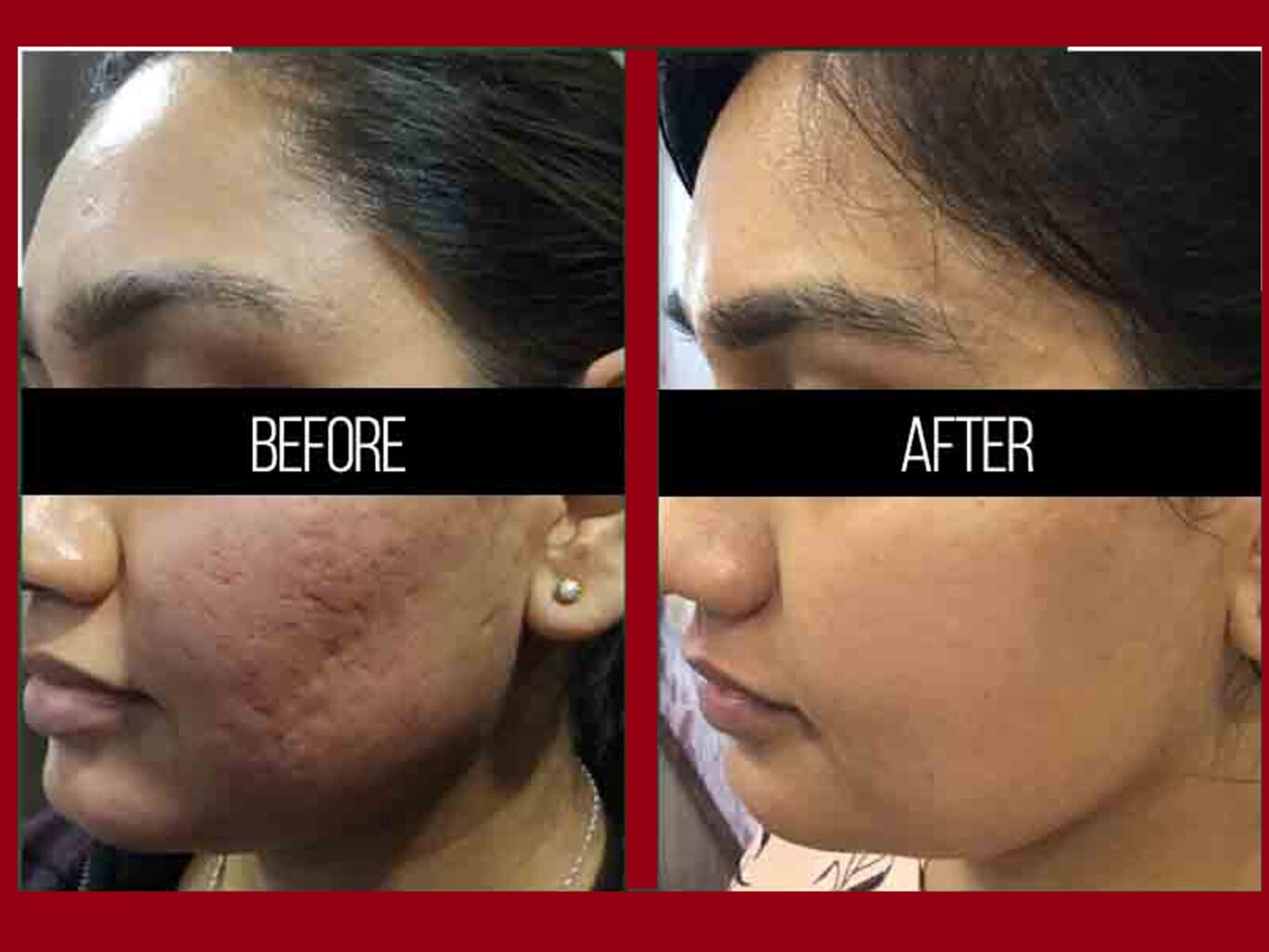 Acne Scar Laser Treatment in Jaipur