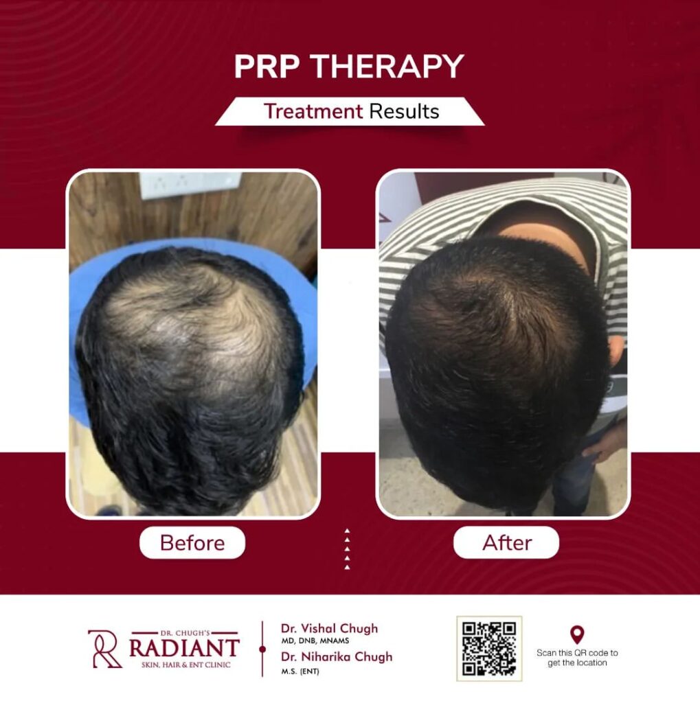 PRP Treatment in Jaipur