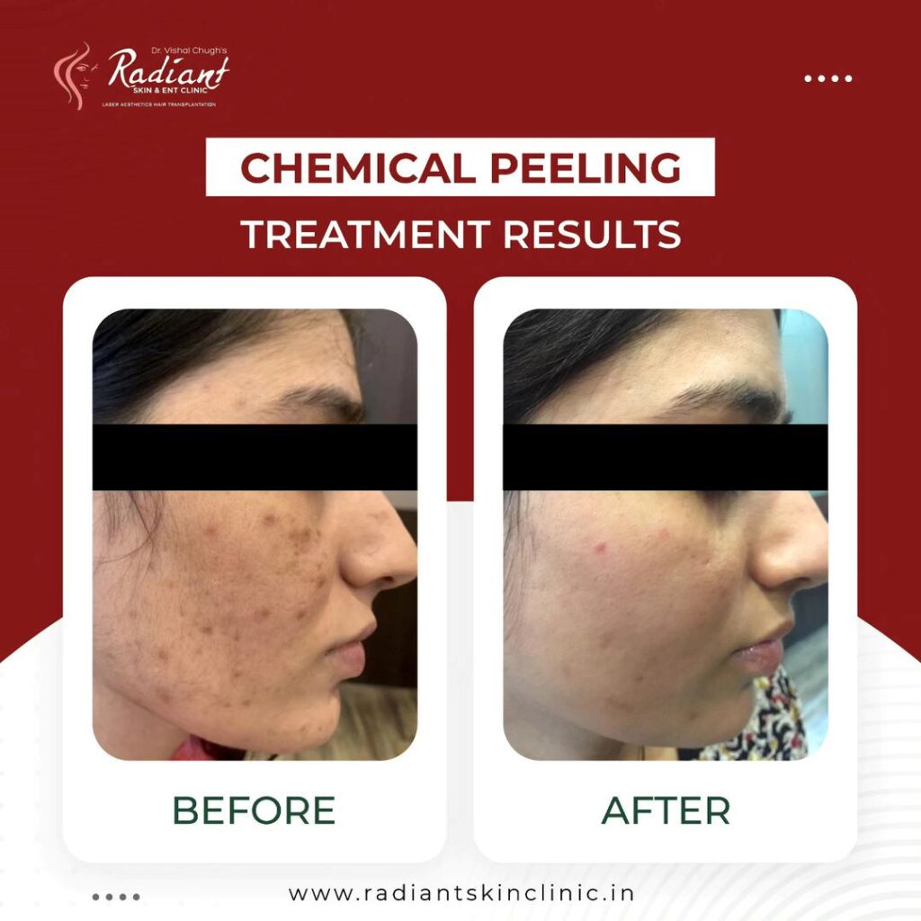 Best Chemical Peel Treatment Jaipur