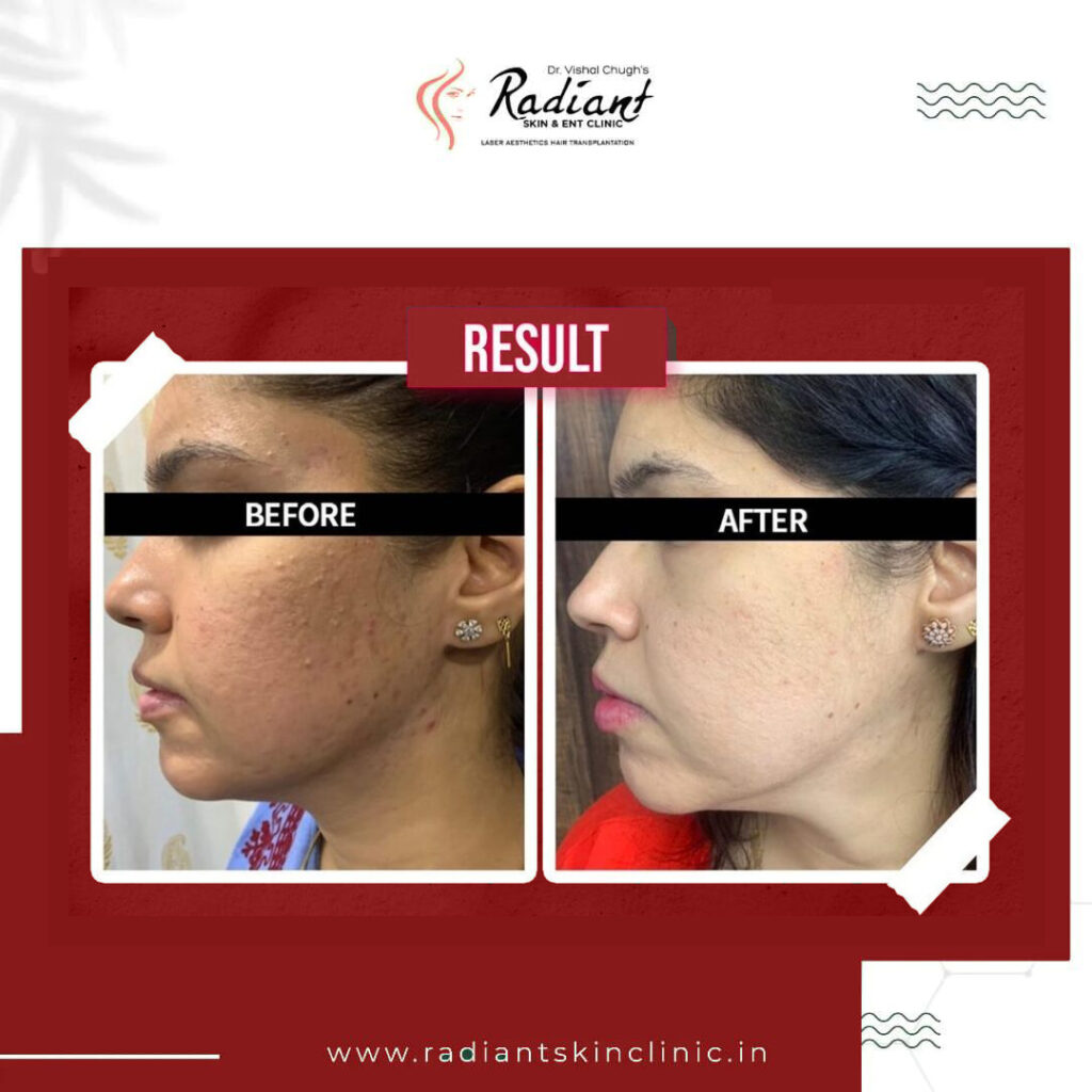 Hydrafacial Treatment in Jaipur