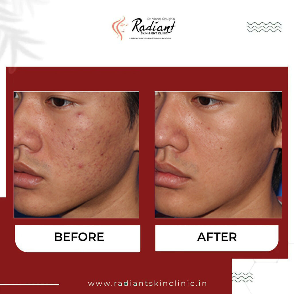 Acne Scar Laser Treatment in Jaipur
