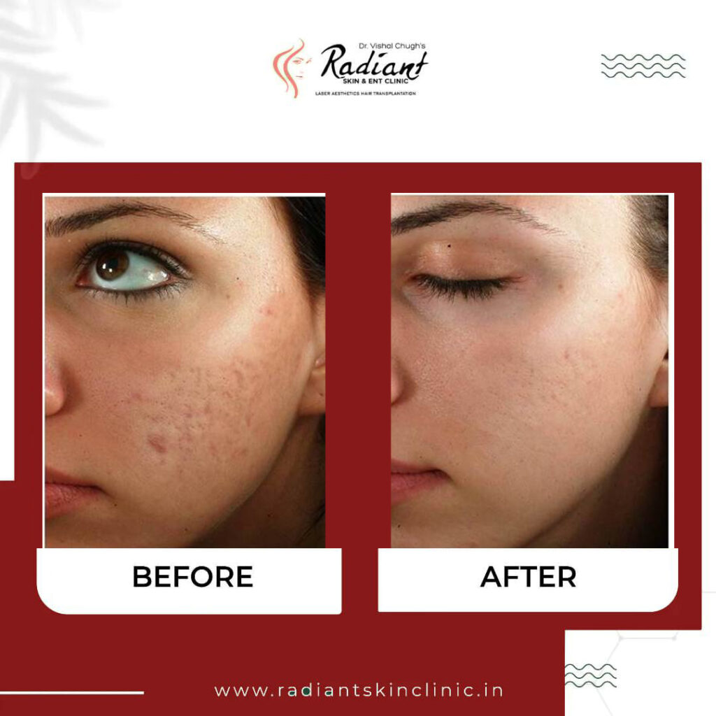 Best Chemical Peel Treatment Jaipur