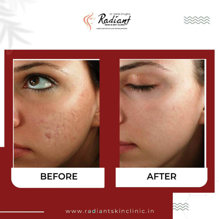 Best Chemical Peel Treatment Jaipur