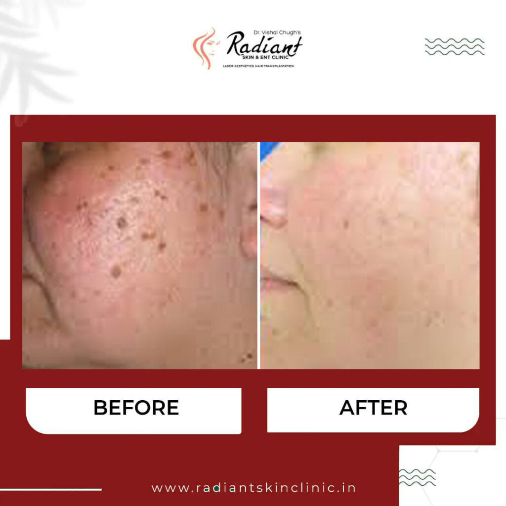 Best Mole Removal Treatment in Jaipur