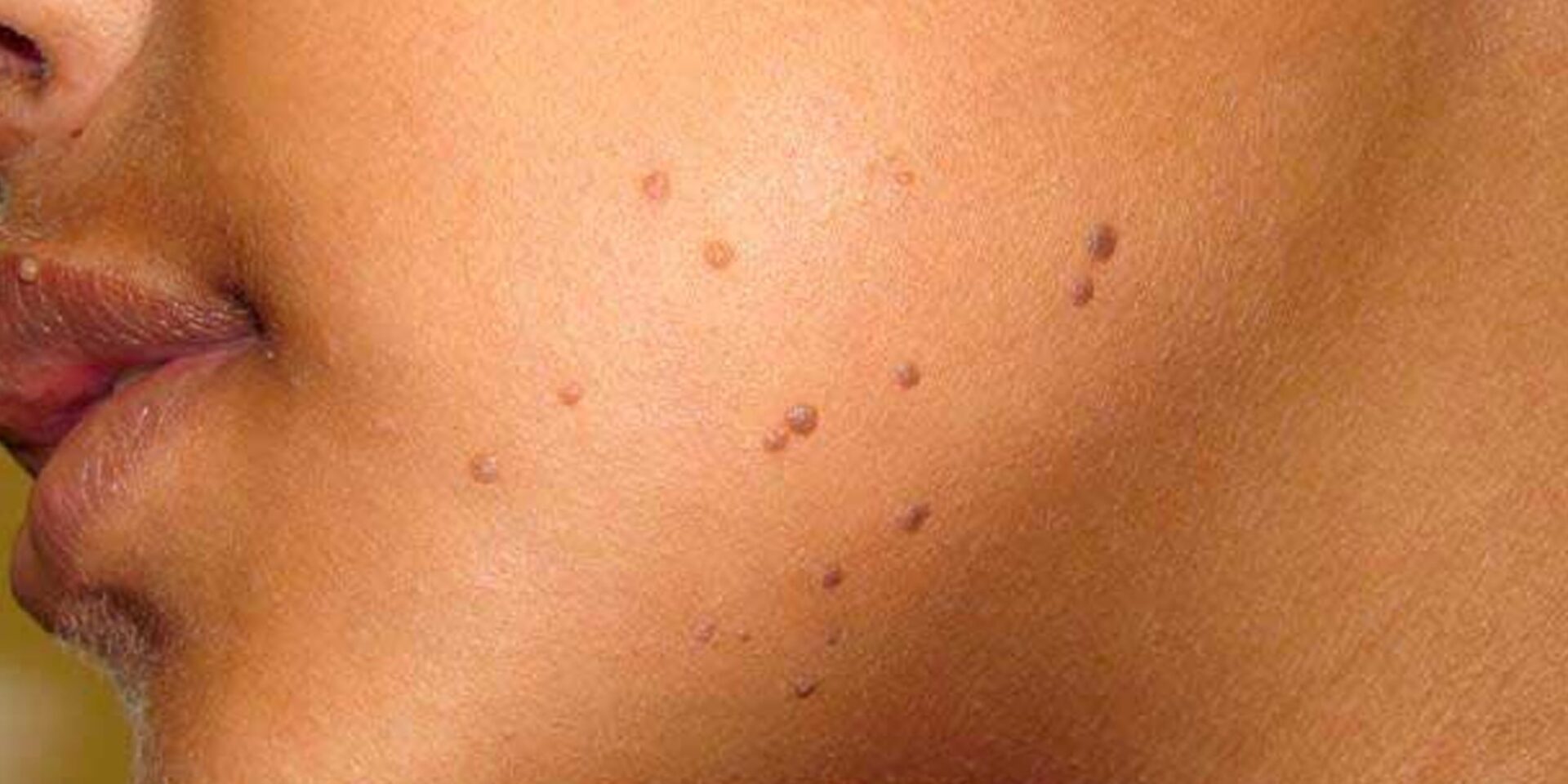 Best Mole Removal Treatment in Jaipur
