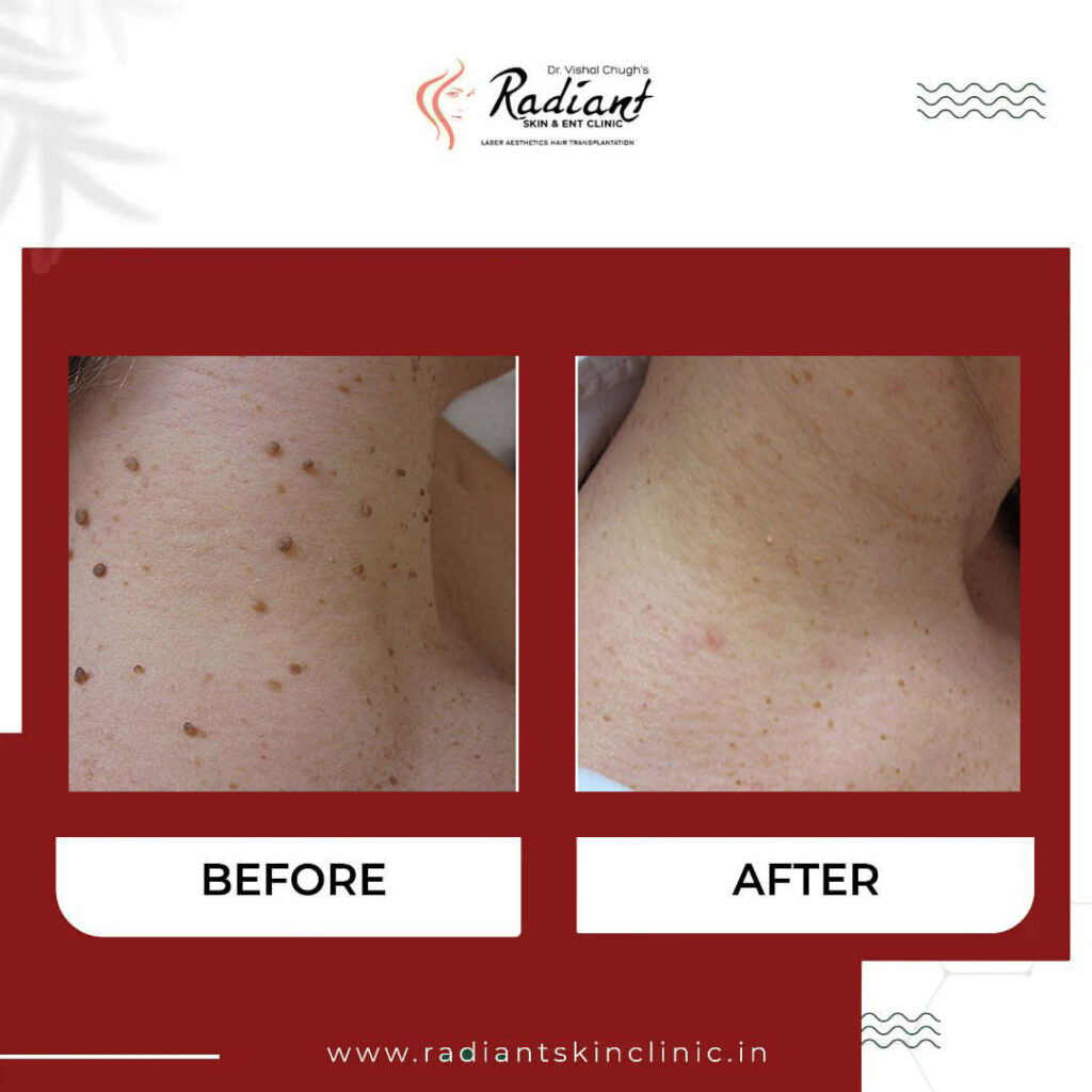 Best Mole Removal Treatment in Jaipur
