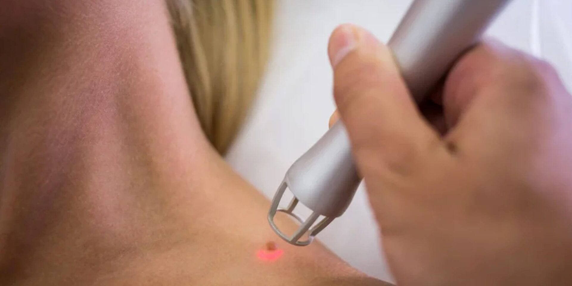 Best Mole Removal Treatment in Jaipur