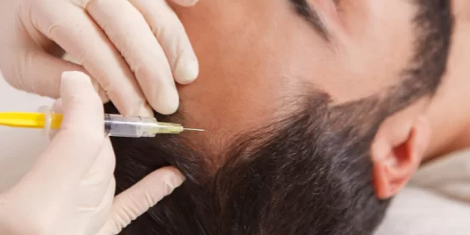 Best PRP Hair Loss Treatment in Jaipur