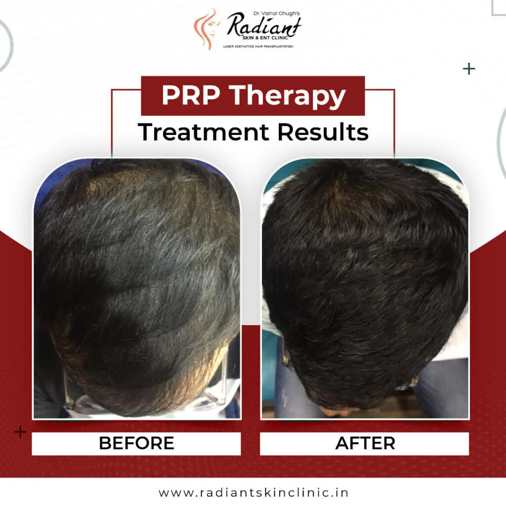 Best PRP Hair Treatment in Jaipur