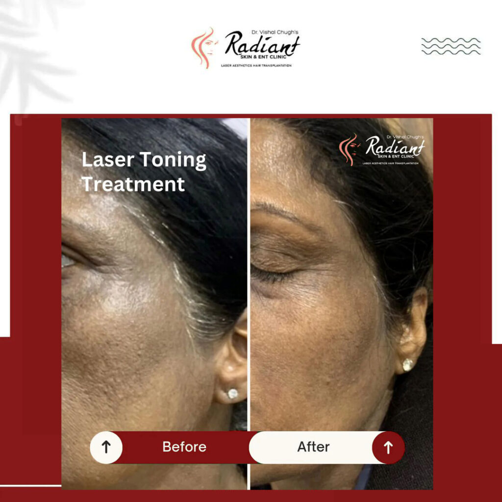 Laser Toning Treatment in Jaipur