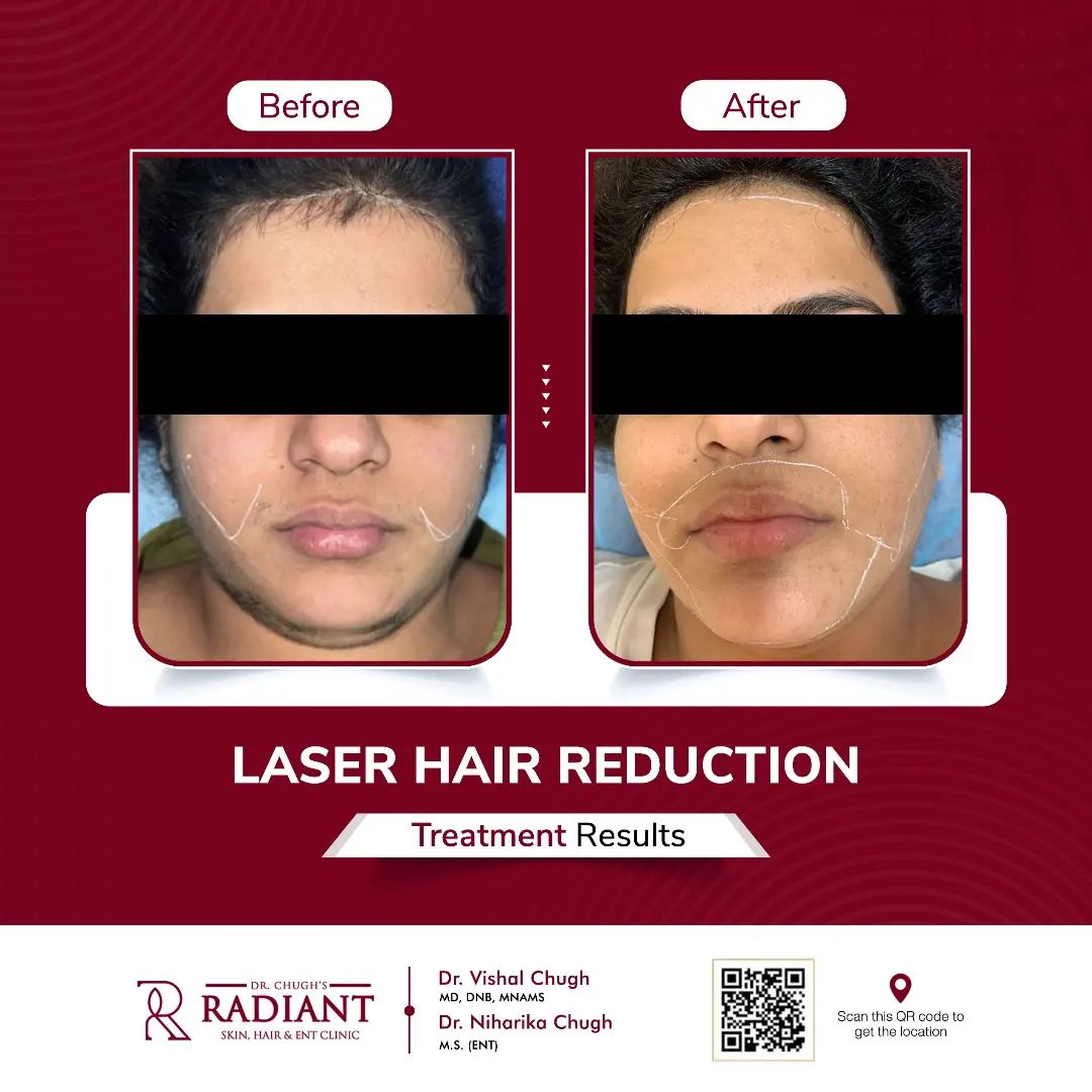 Laser Hair Reduction in Jaipur