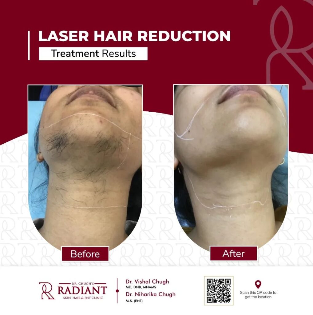 Laser Hair Reduction in Jaipur