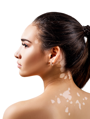 Best Vitiligo Treatment in Jaipur