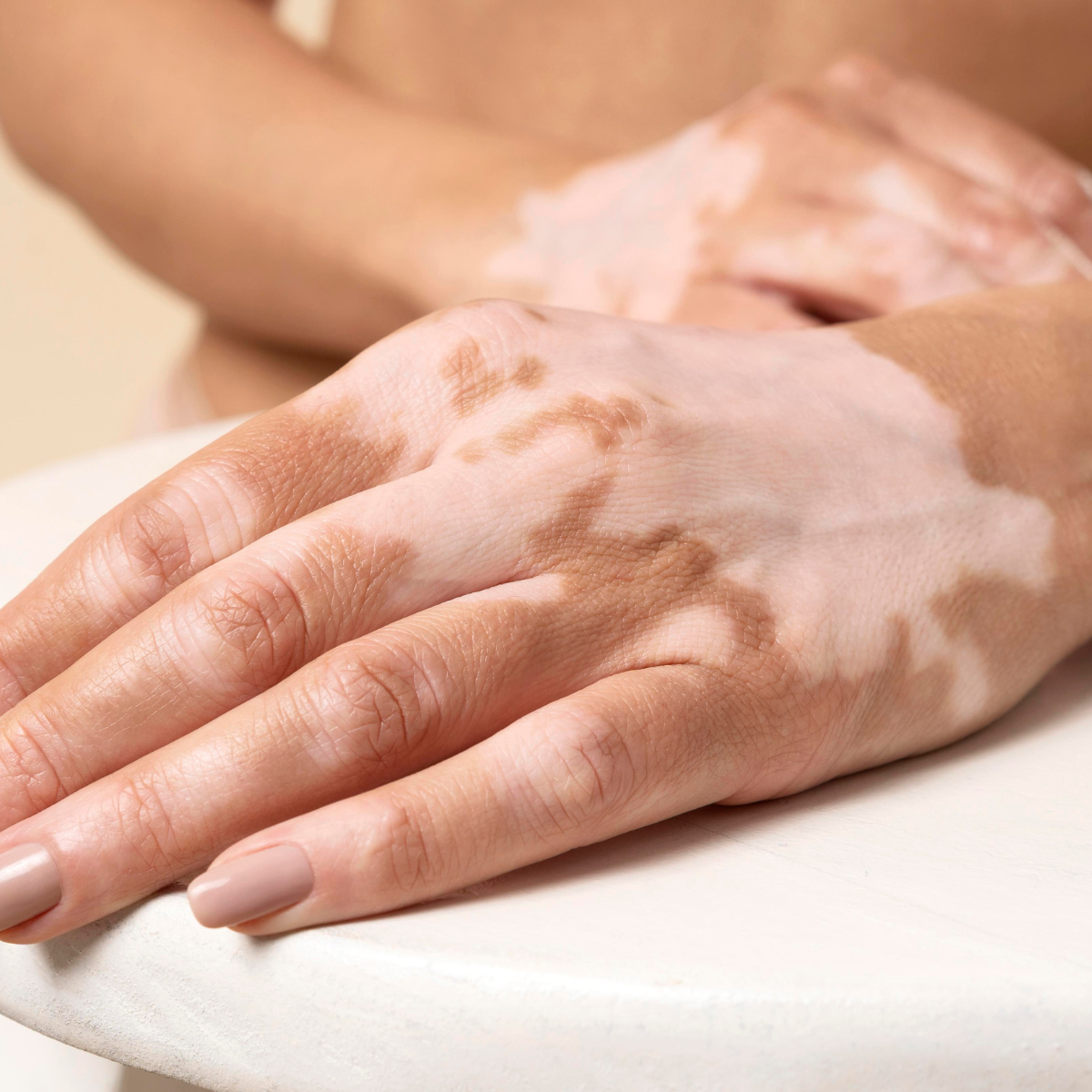 Best Vitiligo Treatment in Jaipur