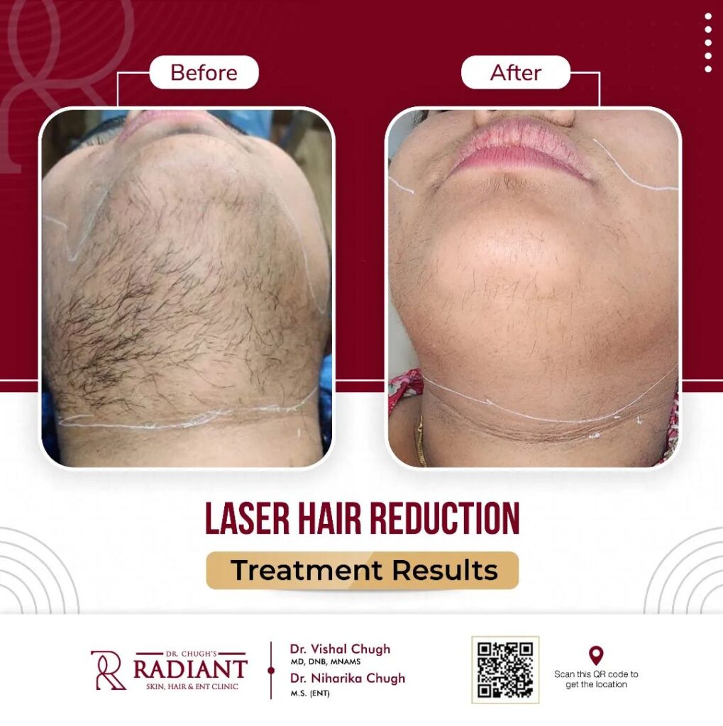 Top laser hair removal clinic in malviya nagar, Jaipur