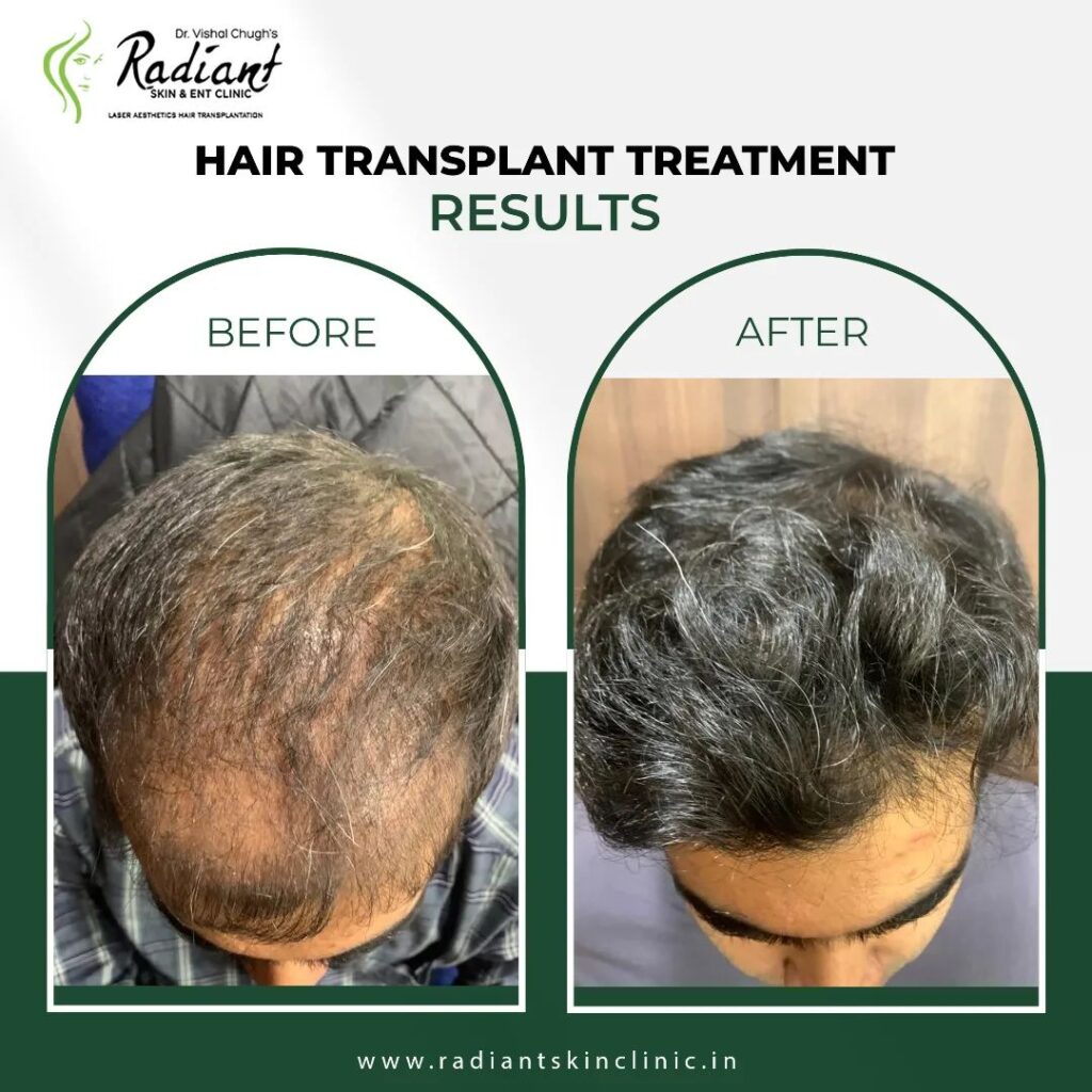 Hair Transplant Cost Jaipur