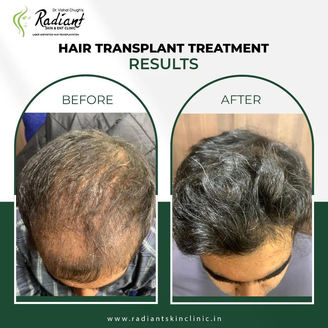 Hair Transplant Cost Jaipur