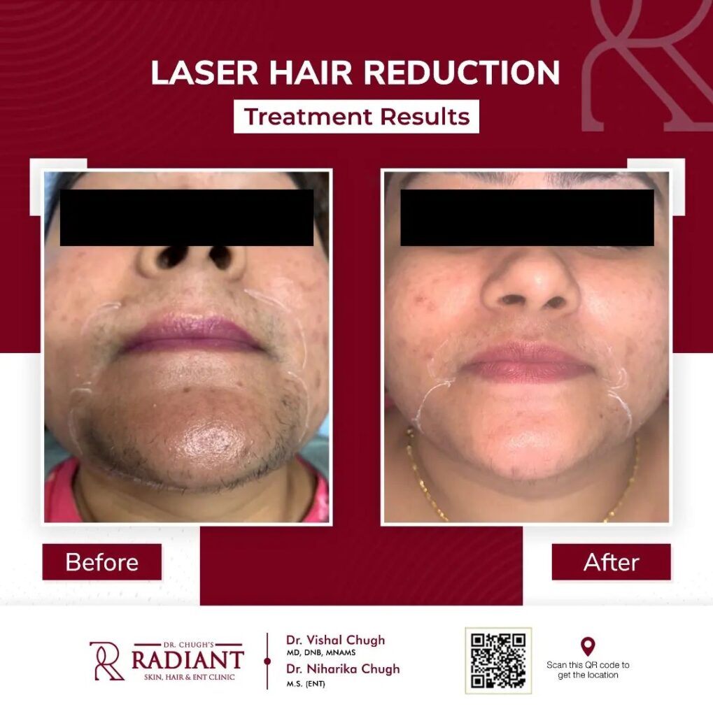 Laser Hair Reduction in Jaipur
