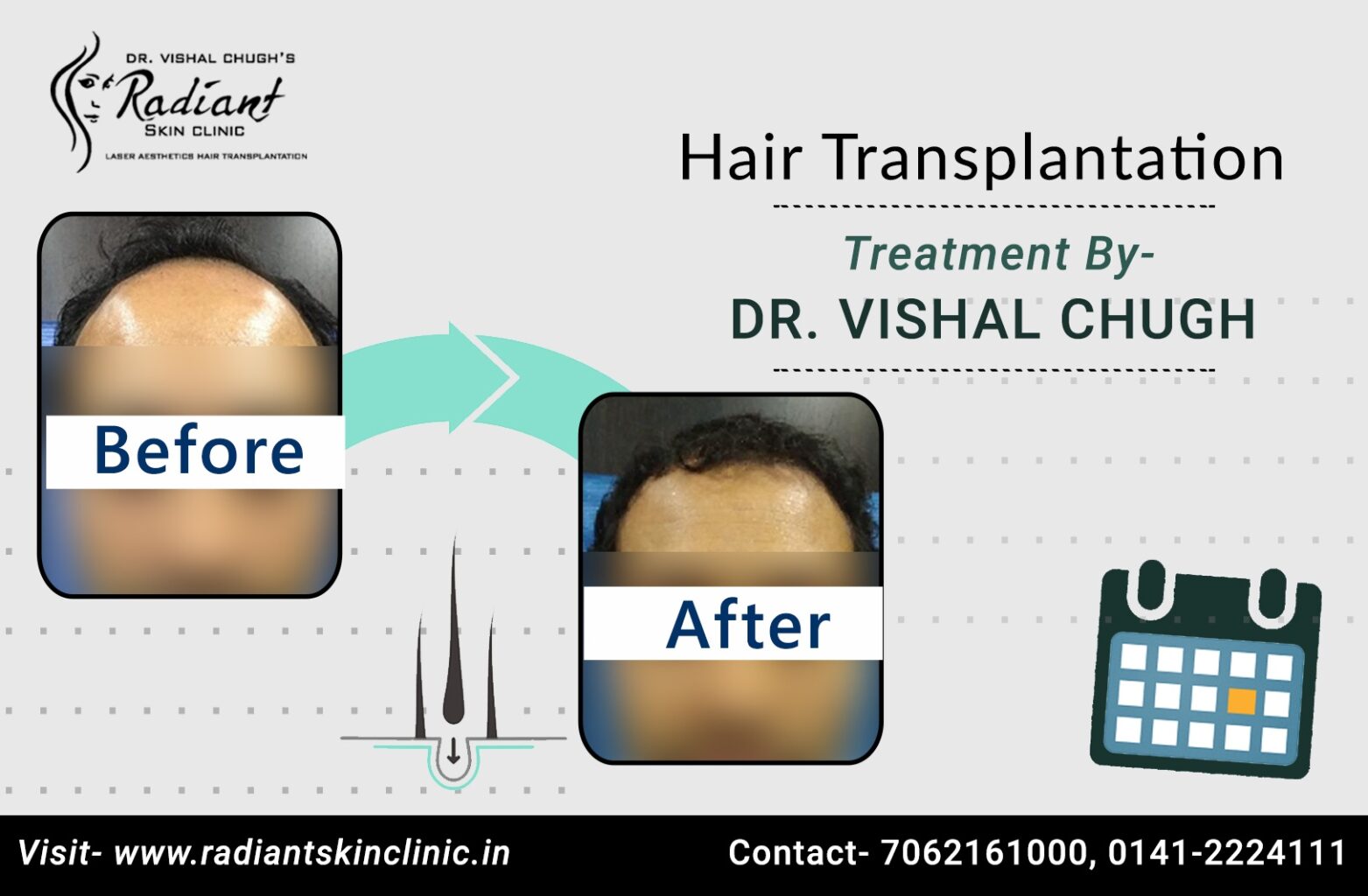 Best Hair Transplant in Jaipur