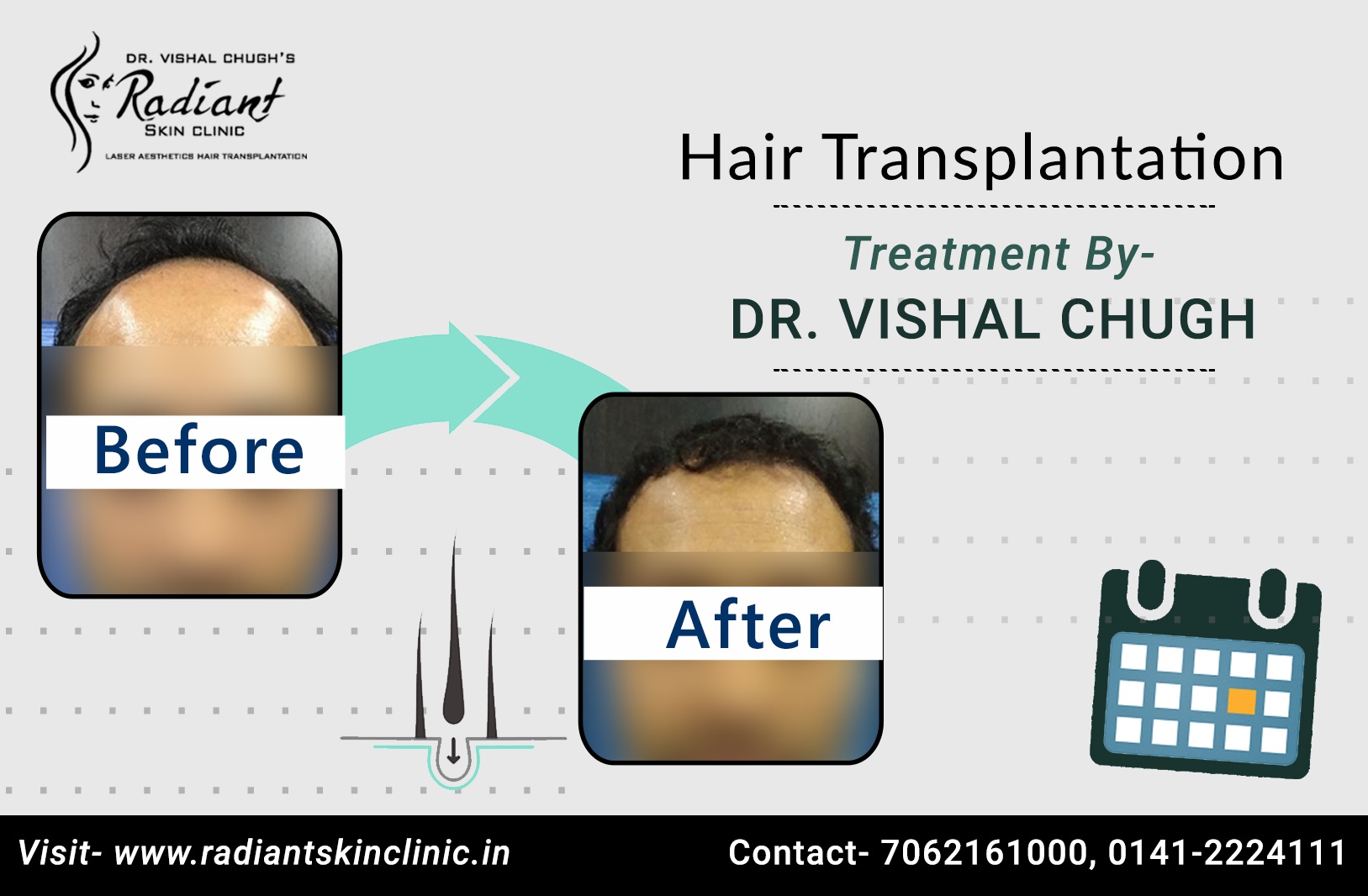 Best Hair Transplant in Jaipur