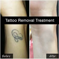 Laser Tattoo Removal Doctor in Jaipur