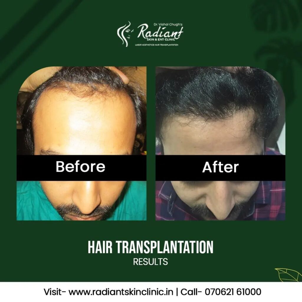 Hair Transplant Cost Jaipur