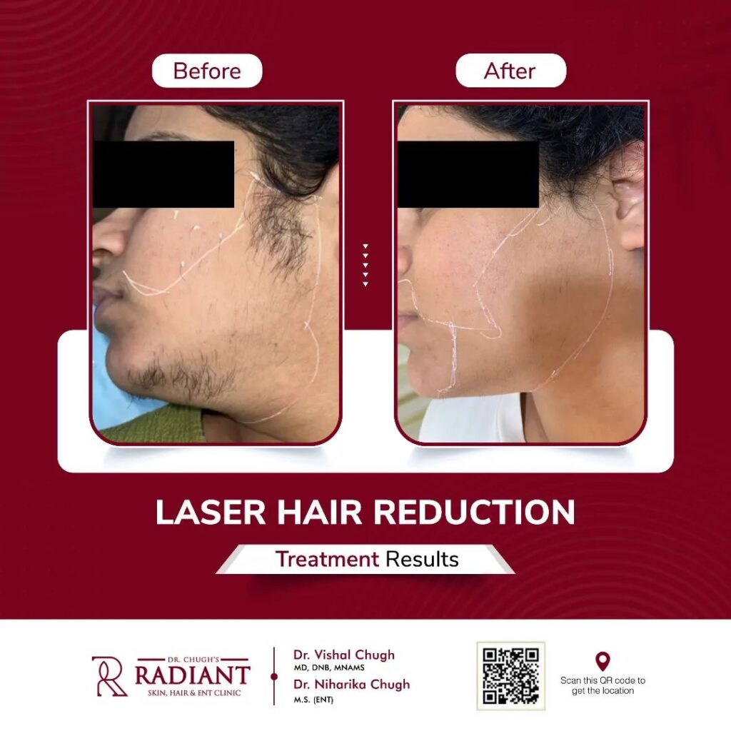 Laser Hair Removal Jaipur