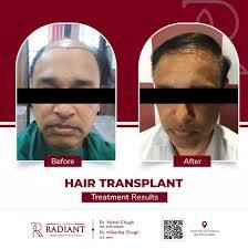 Best Hair Transplants Doctor in Jaipur