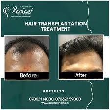 Best Hair Transplant in Jaipur