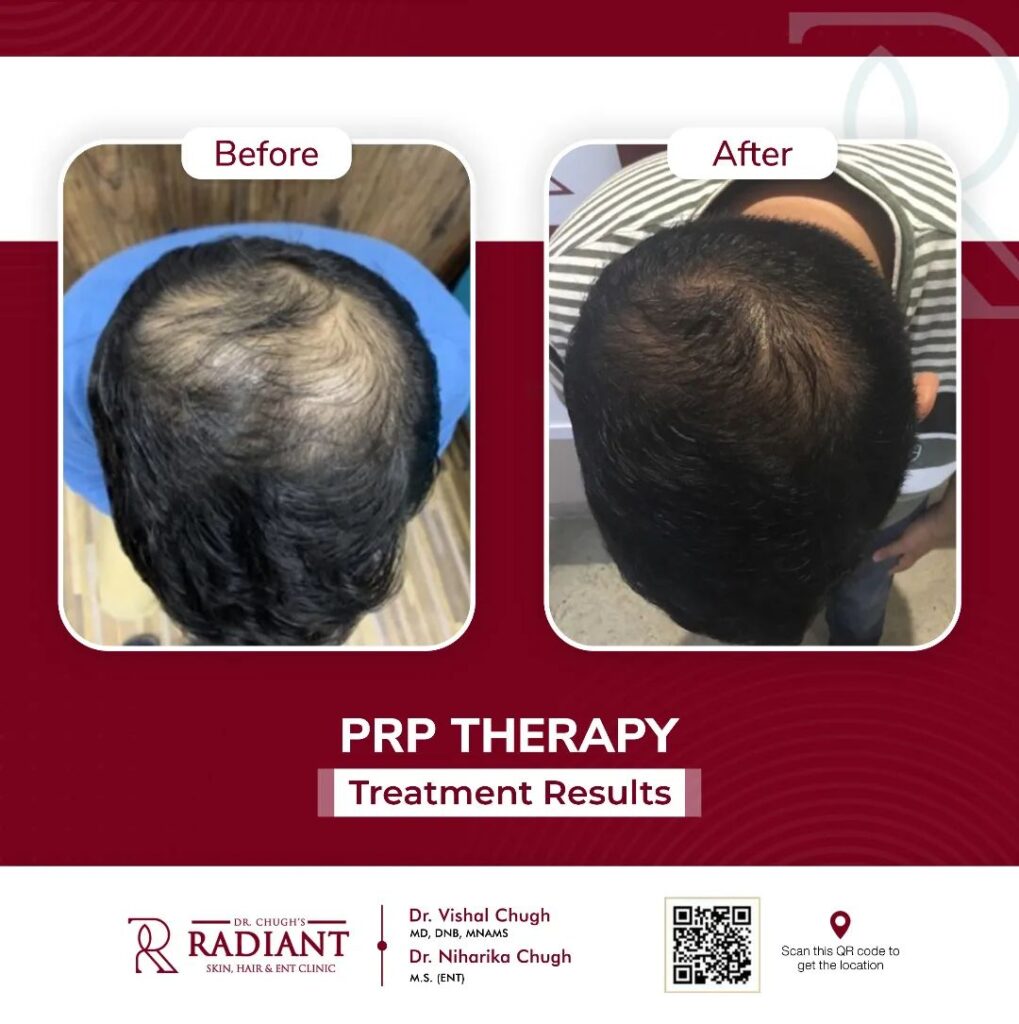 PRP Treatment Cost in Jaipur