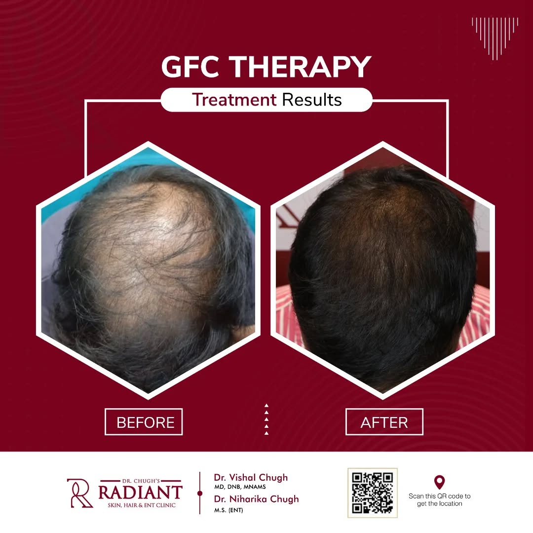 Best GFC Treatment Jaipur