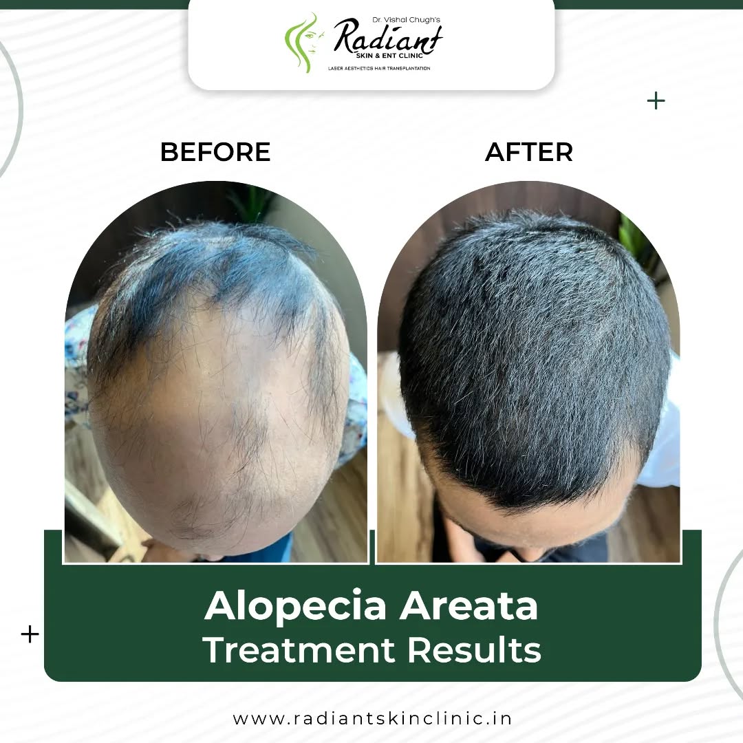 best clinic for alopecia treatment in Jaipur