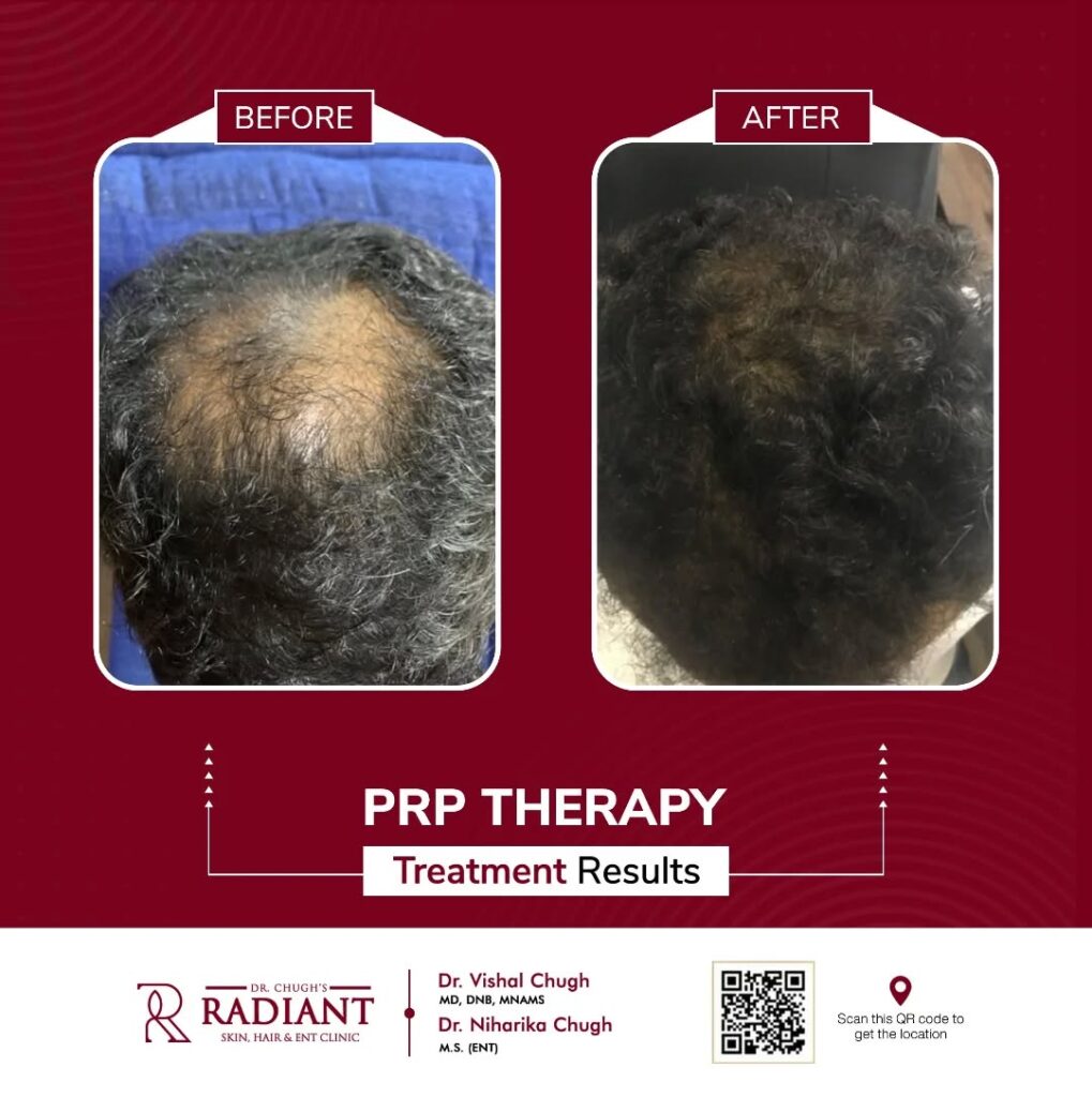 Best Hair Transplant in Jaipur