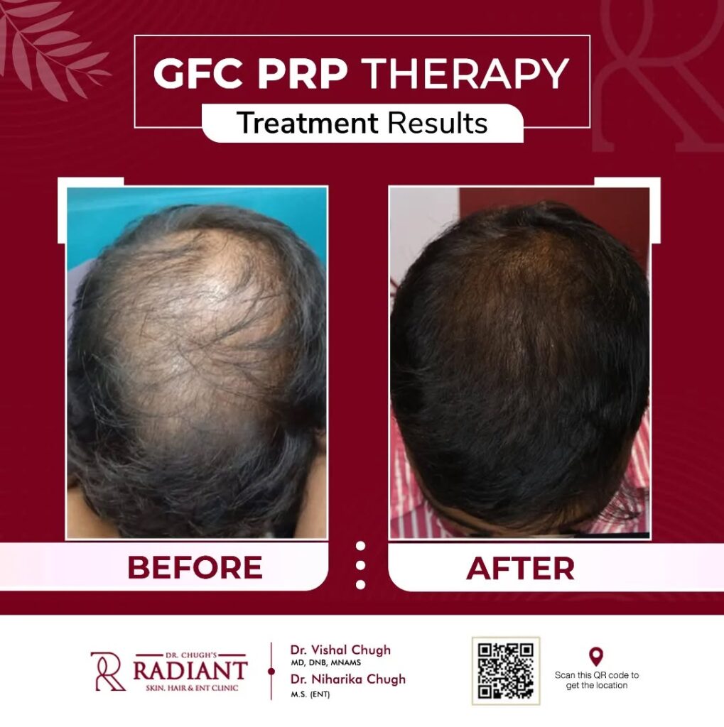 Best Hair Transplant Clinic in Jaipur