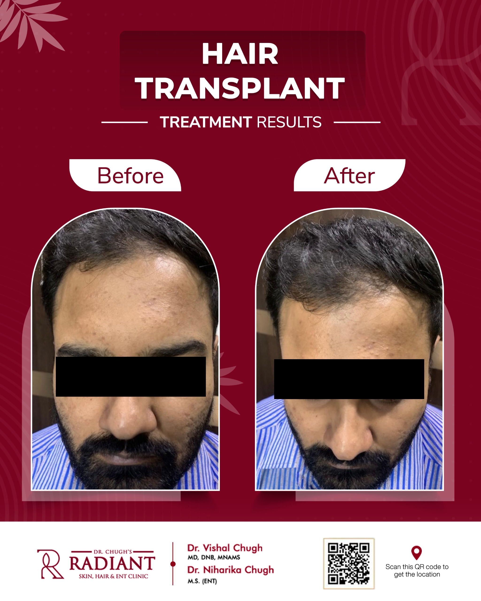 Hair Transplant in Jaipur