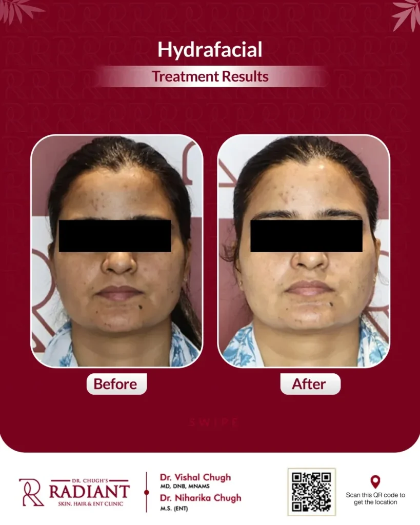 Hydrafacial Treatment in Jaipur
