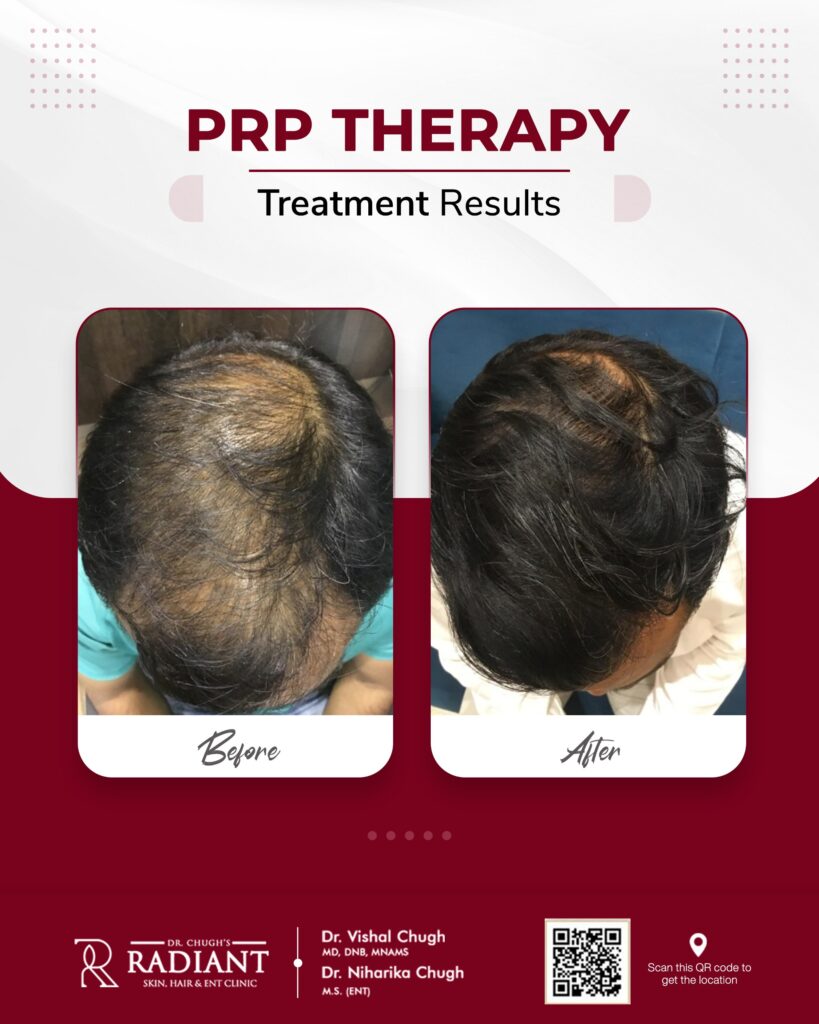 PRP Hair Treatment Jaipur
