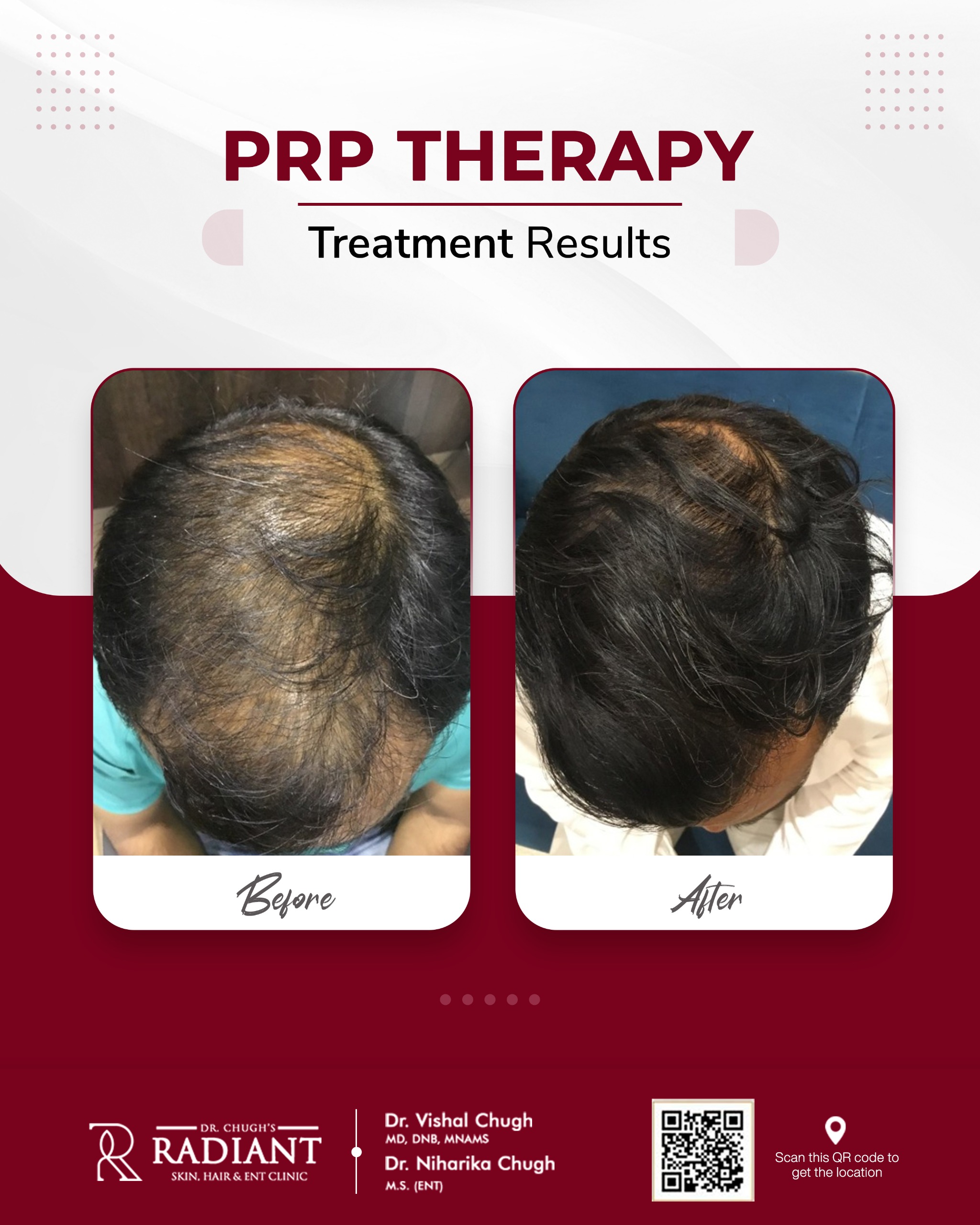 PRP Hair Treatment Jaipur