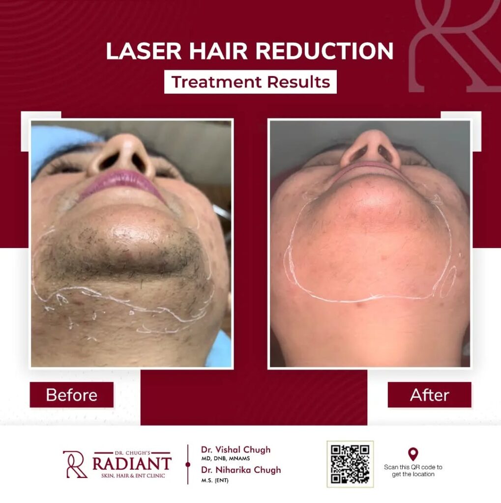 Laser Hair Removal Jaipur