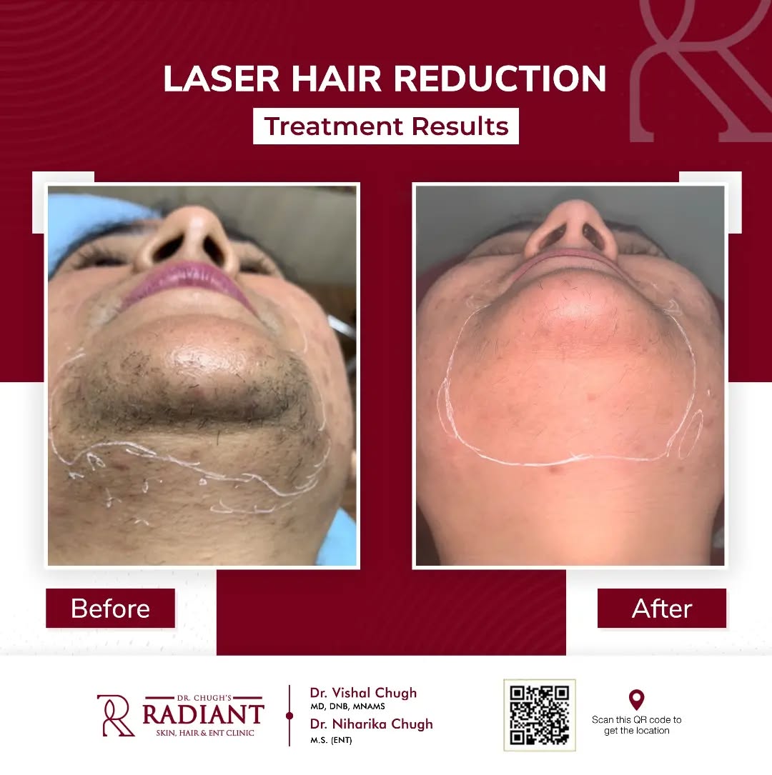 Laser Hair Removal Jaipur