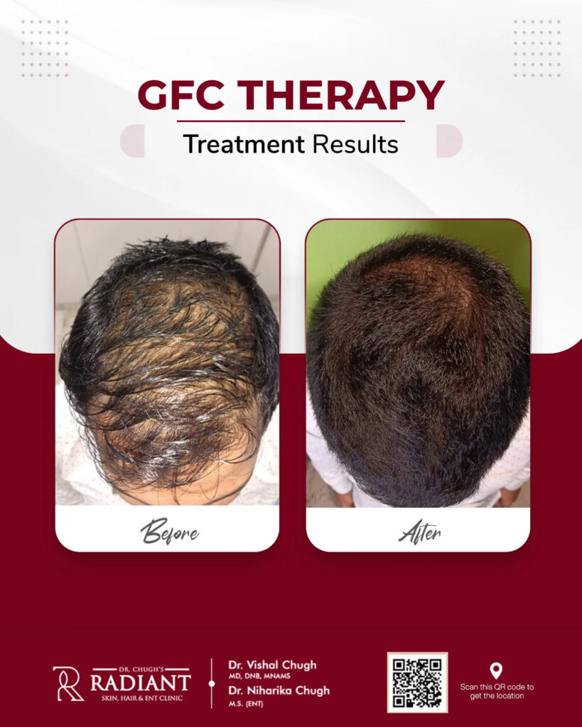 GFC Hair Treatment in Jaipur