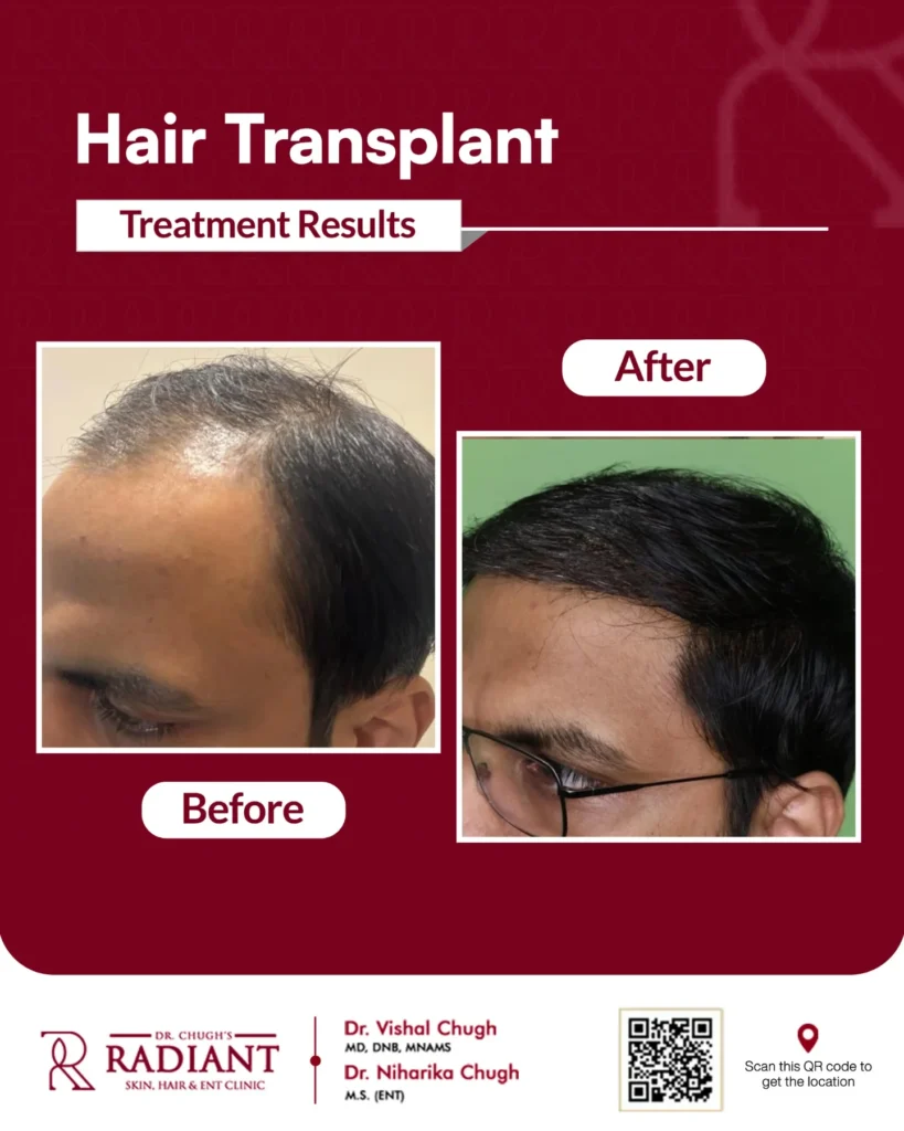 Hair Transplant Cost Jaipur