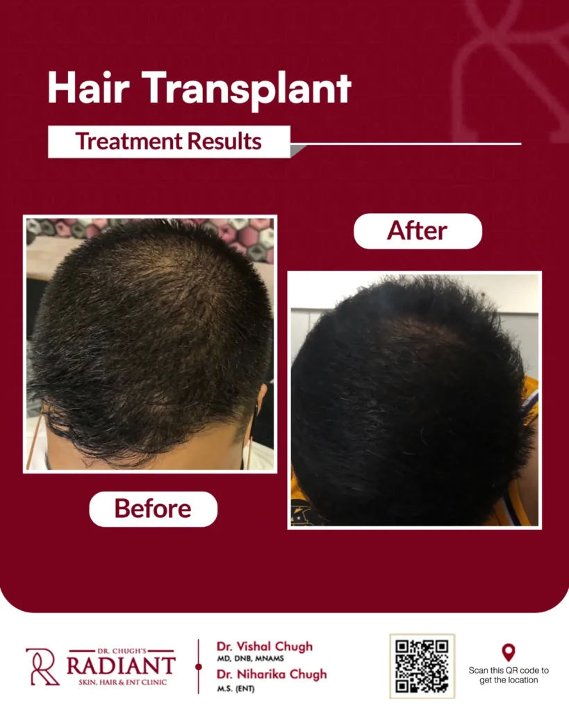 Best Hair Transplant Cost Jaipur